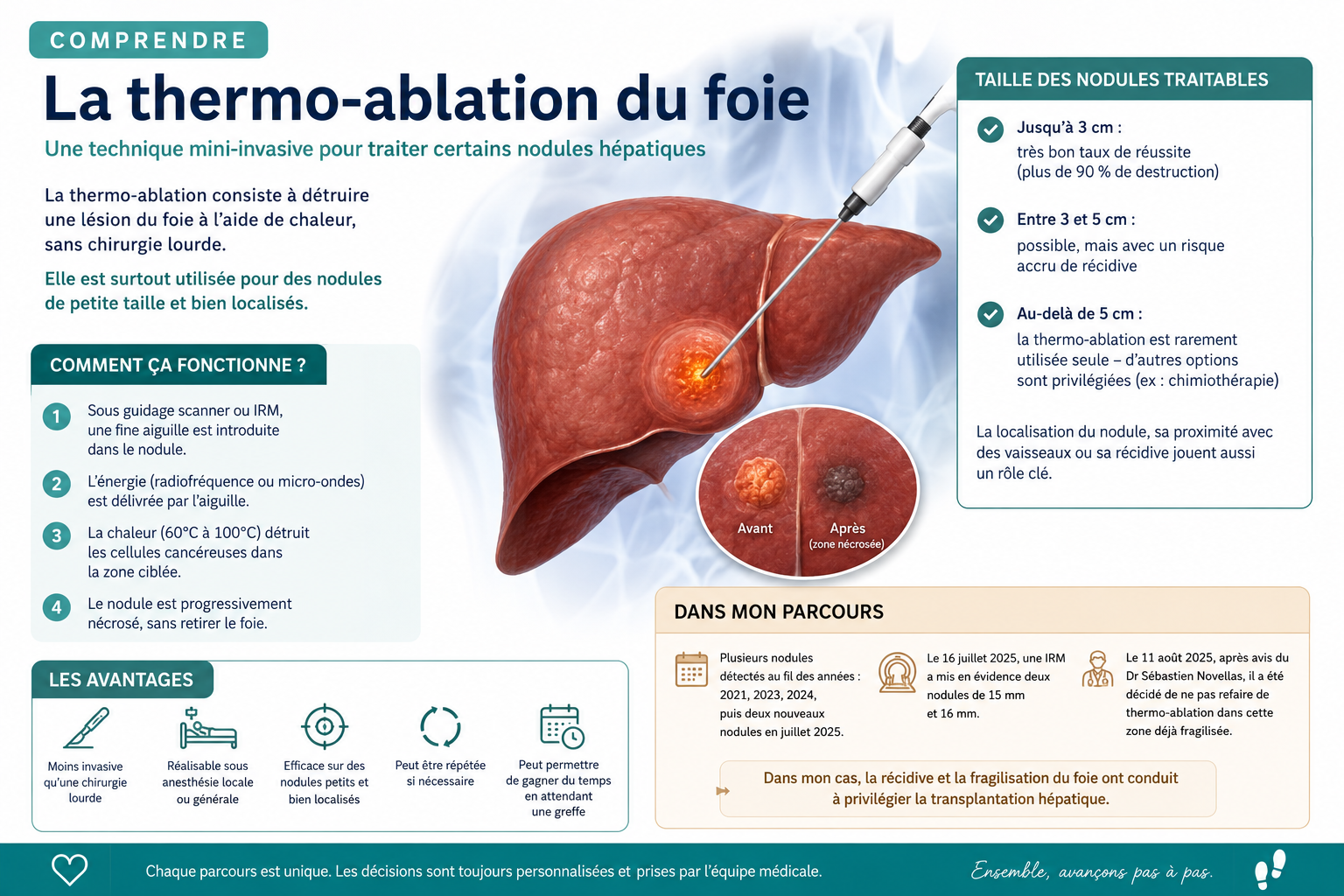 Lire la suite à propos de l’article Comprendre la thermo-ablation du foie